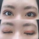二重埋没 湘南美容クリニック 京都院 DAY 15 サムネイル用