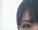 二重埋没 湘南美容クリニック 京都院 DAY 15 サムネイル用