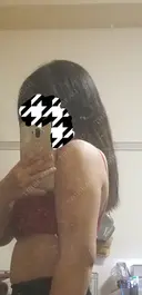 脂肪吸引（二の腕） プチパーティー医院 DAY 4 サムネイル用