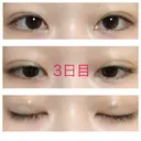 二重埋没 青山セレスクリニック 青山院 DAY 3 サムネイル用