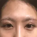 目頭切開 / 上まぶたたるみ取り 湘南美容クリニック 金沢院 DAY 2 サムネイル用