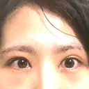 目頭切開 / 上まぶたたるみ取り 湘南美容クリニック 金沢院 DAY 2 サムネイル用