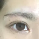 目頭切開 / 上まぶたたるみ取り 湘南美容クリニック 金沢院 DAY 7 サムネイル用