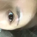 目頭切開 / 上まぶたたるみ取り 湘南美容クリニック 金沢院 DAY 7 サムネイル用