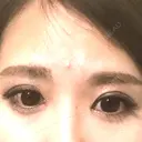 目頭切開 / 上まぶたたるみ取り 湘南美容クリニック 金沢院 AFTER サムネイル用