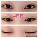 二重埋没 青山セレスクリニック 青山院 DAY 4 サムネイル用