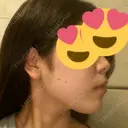 スレッドノーズ / ヒアルロン酸注入（鼻） / ヒアルロン酸注入（あご） / ヒアルロン酸注入（額） キップン整形外科 AFTER サムネイル用