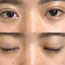 二重埋没 湘南美容クリニック 新宿本院 DAY 7 サムネイル用