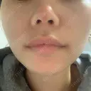 鼻尖形成（切開） / 鼻中隔延長（切開） / 小鼻縮小（切開） / 軟骨移植 HANABI整形外科 DAY 124 サムネイル用