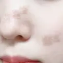 ほくろ・いぼ切除（肌） 赤坂メディカルMクリニック DAY 0 サムネイル用