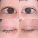 二重切開 / 上まぶたの脂肪取り 湘南美容クリニック 宇都宮院 DAY 20 サムネイル用