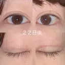 二重切開 / 上まぶたの脂肪取り 湘南美容クリニック 宇都宮院 DAY 22 サムネイル用