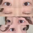 二重切開 / 上まぶたの脂肪取り 湘南美容クリニック 宇都宮院 DAY 22 サムネイル用