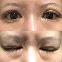 二重切開 / その他（目元） RG整形外科（旧リオン整形外科） DAY 25 サムネイル用