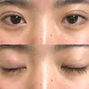 二重埋没 湘南美容クリニック 新宿本院 DAY 8 サムネイル用