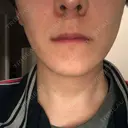 エレクトロポレーション 湘南美容クリニック 秋葉原院 DAY 2 サムネイル用