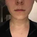 エレクトロポレーション 湘南美容クリニック 秋葉原院 DAY 3 サムネイル用