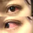 二重切開 大阪梅田中央クリニック美容外科 DAY 14 サムネイル用