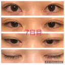 二重埋没 青山セレスクリニック 青山院 DAY 7 サムネイル用