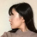 骨切り（あご） / 骨削り（エラ） / 骨削り（頬） RG整形外科（旧リオン整形外科） DAY 122 サムネイル用