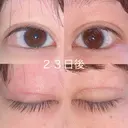 二重切開 / 上まぶたの脂肪取り 湘南美容クリニック 宇都宮院 DAY 23 サムネイル用