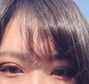 二重埋没 湘南美容クリニック 京都院 DAY 20 サムネイル用