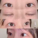 二重切開 / 上まぶたの脂肪取り 湘南美容クリニック 宇都宮院 DAY 24 サムネイル用