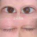 二重切開 / 上まぶたの脂肪取り 湘南美容クリニック 宇都宮院 DAY 24 サムネイル用