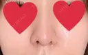 隆鼻術 / 鼻尖形成（切開） / 軟骨移植 湘南美容クリニック 名古屋栄院 DAY 31 サムネイル用