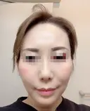 その他（目元） / クマ治療 / 額を丸く / その他（輪郭） / 下まぶたの脂肪取り / 脂肪注入（肌） / こめかみ形成 / 脂肪注入（額） / ヒアルロン酸注入（涙袋） / 脂肪注入（輪郭） / PRP皮膚再生療法 ジュエリー美容外科 DAY 28 サムネイル用