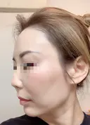その他（目元） / クマ治療 / 額を丸く / その他（輪郭） / 下まぶたの脂肪取り / 脂肪注入（肌） / こめかみ形成 / 脂肪注入（額） / ヒアルロン酸注入（涙袋） / 脂肪注入（輪郭） / PRP皮膚再生療法 ジュエリー美容外科 DAY 28 サムネイル用