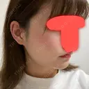 脂肪吸引（顔） / ボトックス（エラ・小顔） / 美容点滴・美容注射（美肌） エートップ美容整形外科 DAY 30 サムネイル用