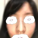 鼻尖形成（切開） / 軟骨移植 白山クリニック 大分 AFTER サムネイル用