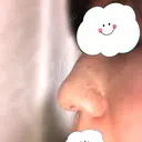 鼻尖形成（切開） / 軟骨移植 白山クリニック 大分 DAY 39 サムネイル用