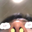 鼻尖形成（切開） / 軟骨移植 白山クリニック 大分 DAY 39 サムネイル用