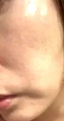 イオン導入 / 美肌レーザー / シミ取りレーザー / フォトRF / YAGレーザー / ニキビ治療 お肌のクリニック　高田馬場 DAY 29 サムネイル用