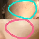 イオン導入 / 美肌レーザー / シミ取りレーザー / フォトRF / YAGレーザー / ニキビ治療 お肌のクリニック　高田馬場 DAY 29 サムネイル用