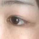 二重埋没 盛岡タウン形成外科クリニック DAY 54 サムネイル用