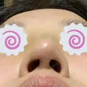 鼻修正 たにまちクリニック DAY 8 サムネイル用