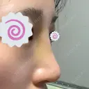鼻修正 たにまちクリニック DAY 8 サムネイル用