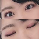 二重埋没 湘南美容クリニック 京都院 DAY 22 サムネイル用