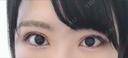 二重埋没 湘南美容クリニック 京都院 AFTER サムネイル用