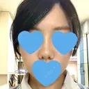 小鼻縮小（切開） / スレッドノーズ / ヒアルロン酸注入（鼻） キップン整形外科 DAY 8 サムネイル用