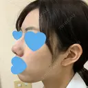 小鼻縮小（切開） / スレッドノーズ / ヒアルロン酸注入（鼻） キップン整形外科 DAY 32 サムネイル用