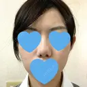 小鼻縮小（切開） / スレッドノーズ / ヒアルロン酸注入（鼻） キップン整形外科 AFTER サムネイル用