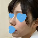 小鼻縮小（切開） / スレッドノーズ / ヒアルロン酸注入（鼻） キップン整形外科 DAY 11 サムネイル用