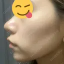 鼻尖形成（切開） / 鼻中隔延長（切開） / 小鼻縮小（切開） / 軟骨移植 HANABI整形外科 DAY 128 サムネイル用