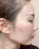 その他（目元） / クマ治療 / 額を丸く / その他（輪郭） / 下まぶたの脂肪取り / 脂肪注入（肌） / こめかみ形成 / 脂肪注入（額） / ヒアルロン酸注入（涙袋） / 脂肪注入（輪郭） / PRP皮膚再生療法 ジュエリー美容外科 DAY 31 サムネイル用