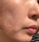 イオン導入 / 美肌レーザー / シミ取りレーザー / フォトRF / YAGレーザー / ニキビ治療 お肌のクリニック　高田馬場 DAY 32 サムネイル用