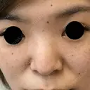 隆鼻術 城本クリニック 岡山院 DAY 60 サムネイル用